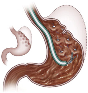 Plicature Chirurgie Des Maladies