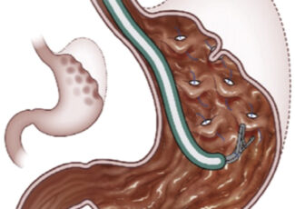 Plicature Gastrique Endoscopique