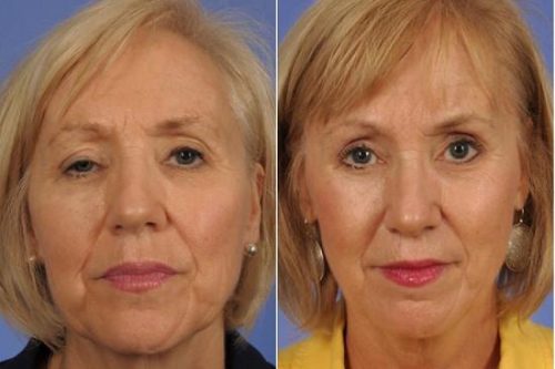 chirurgie-des-paupieres-24378
