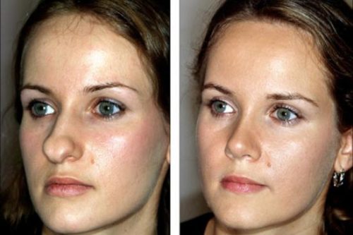 chirurgie-pointe-nez-76680
